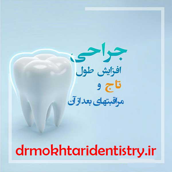 مراقبتهای پس از جراحی لثه (افزایش طول تاج دندان)