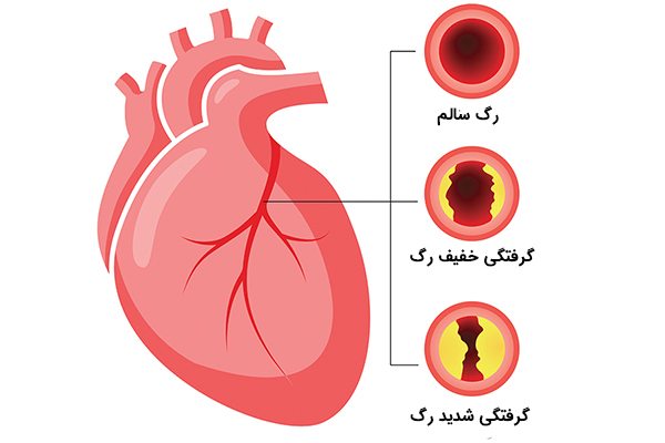 درصد گرفتگی رگ قلب چطور مشخص می شود؟