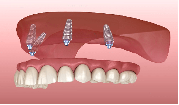 یکی از تکنیک ها در کاشت ایمپلنت دندان، تکنیک all on 4 است.