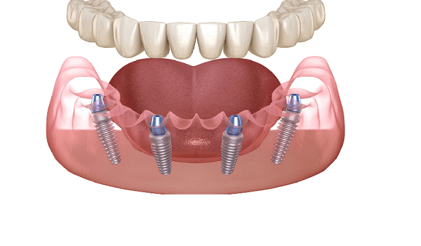  کاشت ایمپلنت دندان all on4 در فک پایین نیز انجام میشود