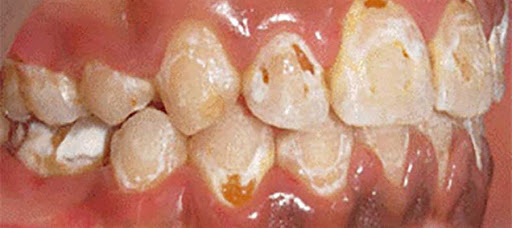 عوارض بریس دندان