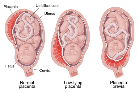 پایین بودن جفت در بارداری چه خطرات و عوارضی دارد؟ pregnancy low placenta