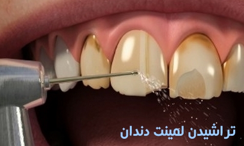 نصب لمینت دندان دندان چقدر طول می کشد
