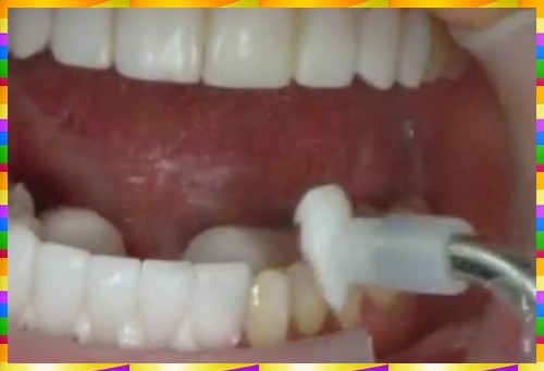 روکش ها  لمینت چگونه روی دندان ها قرار می گیرند