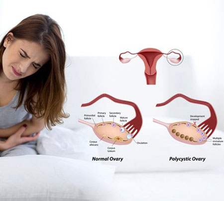 تخمدان پلی کیستیک Polycystic ovary
