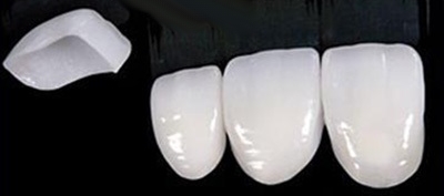 نکات تغییر شکل دندان پس از مراقبت